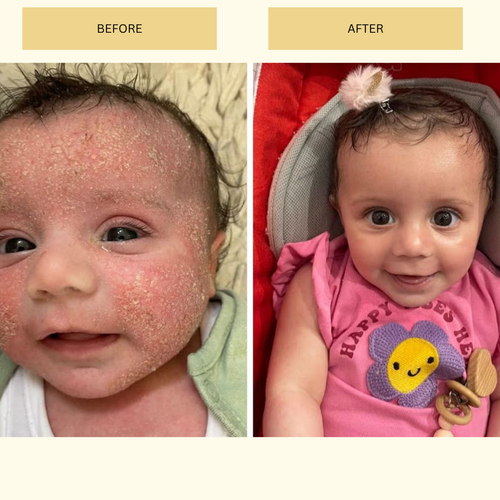 Eczema Cream