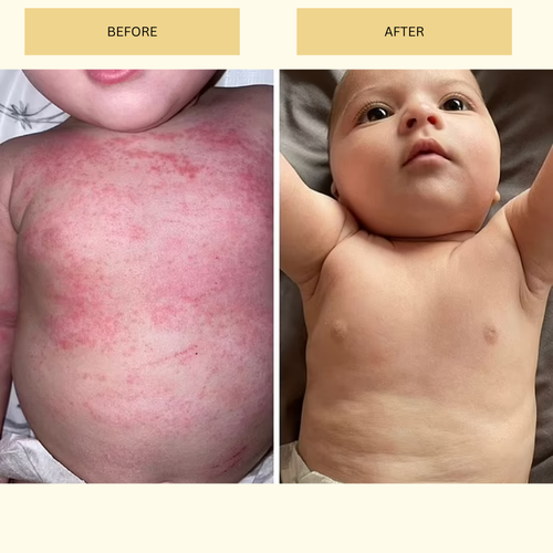 Eczema Cream